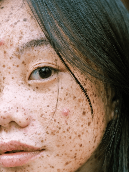 Acne-Prone Skin